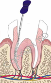 Root Canal Expert 11717